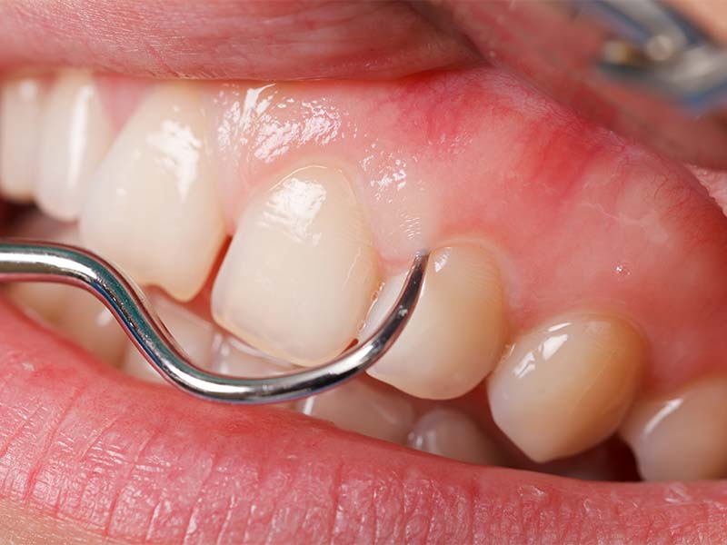 歯周病安定期治療とは？